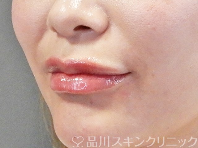 症例NO.67708のAFTER写真