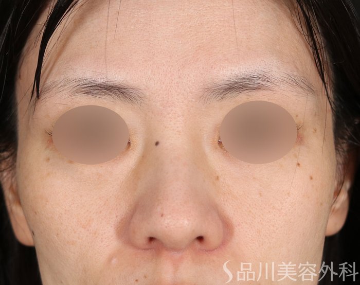 症例NO.71824のBEFORE写真