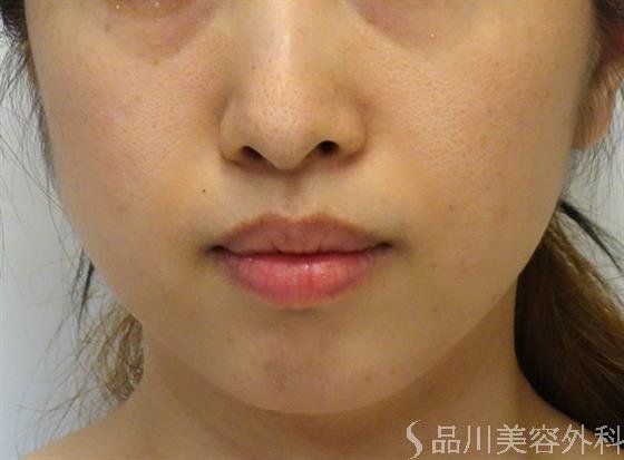 症例NO.39685のBEFORE写真