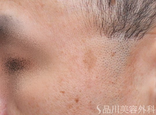 症例NO.67758のBEFORE写真