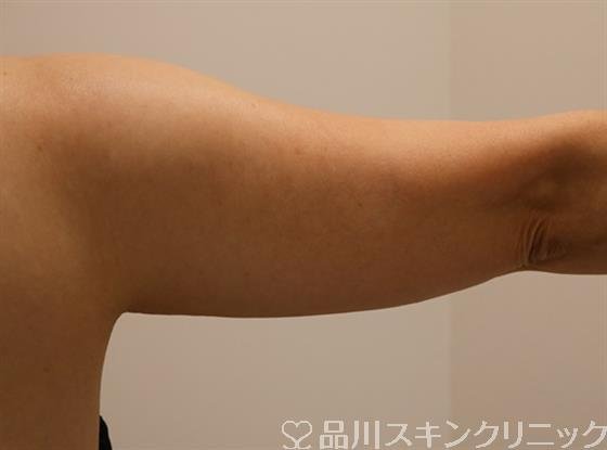 症例NO.43403のBEFORE写真