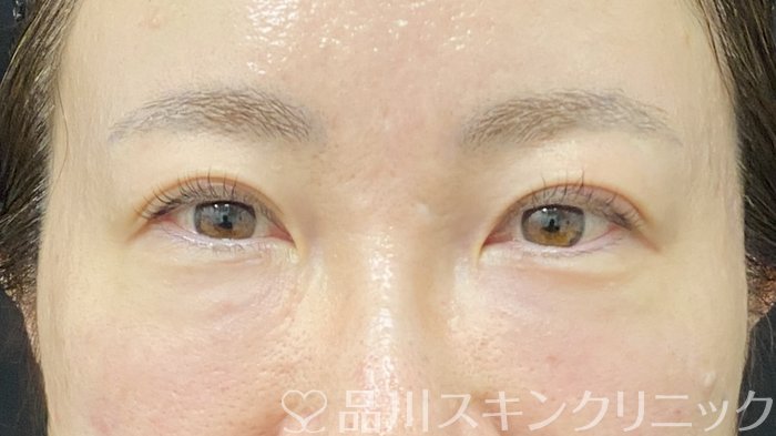 症例NO.74592のAFTER写真