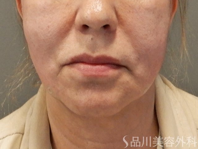 症例NO.72959のAFTER写真