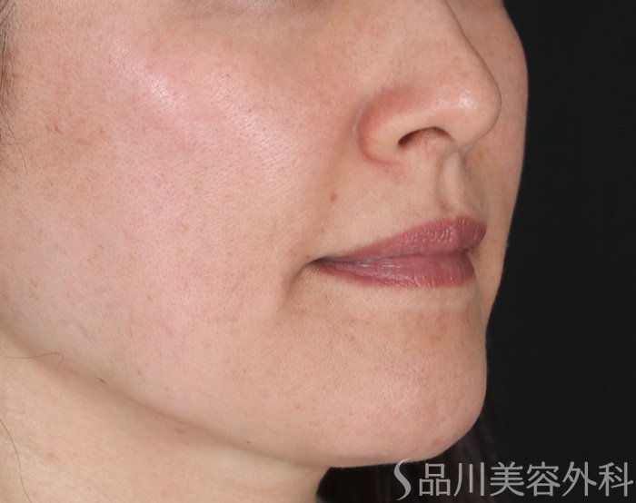 症例NO.72322のBEFORE写真