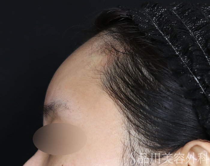症例NO.70836のAFTER写真