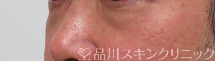 症例NO.65292のBEFORE写真