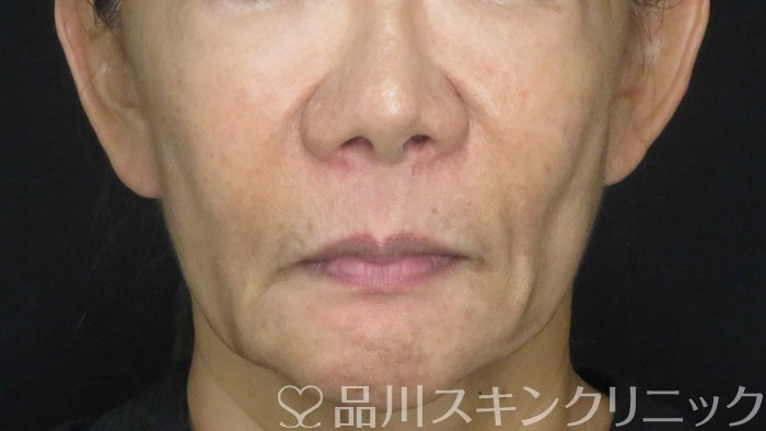 症例NO.71467のBEFORE写真