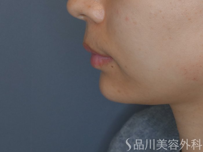 症例NO.69659のAFTER写真