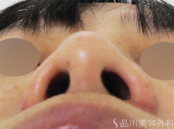 症例NO.27504のAFTER写真