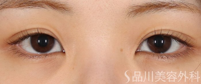 症例NO.72334のBEFORE写真