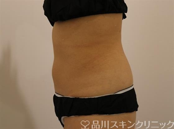 症例NO.43840のAFTER写真