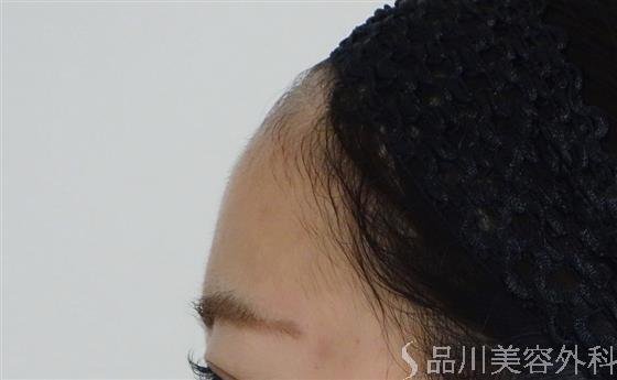症例NO.48425のBEFORE写真