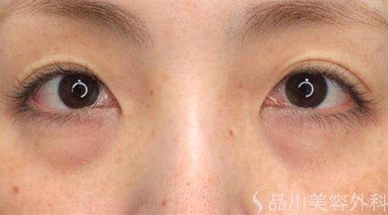 症例NO.59540のBEFORE写真