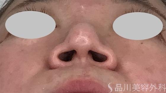 症例NO.59764のBEFORE写真