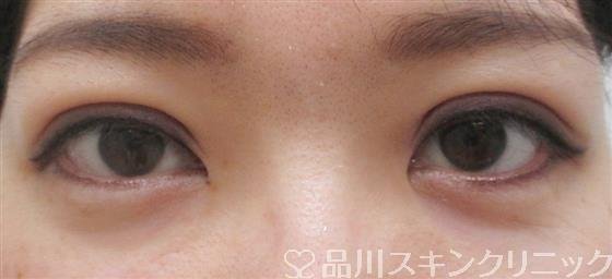 症例NO.27574のAFTER写真