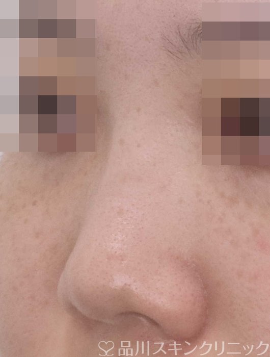 症例NO.67497のBEFORE写真