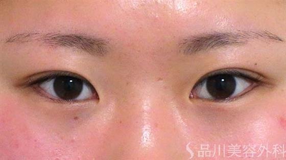 症例NO.26258のAFTER写真