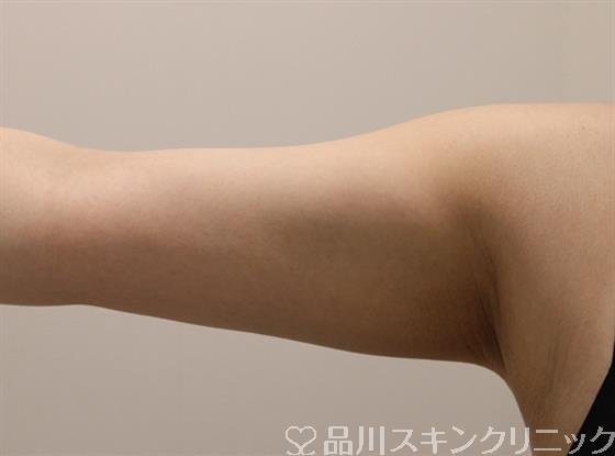 症例NO.47360のAFTER写真