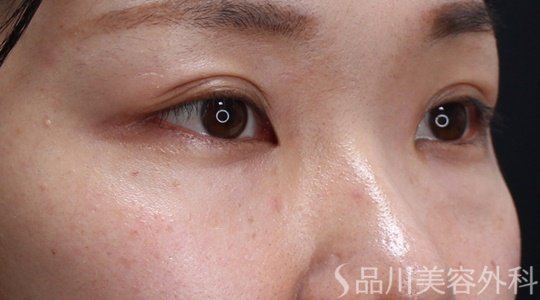 症例NO.69599のAFTER写真