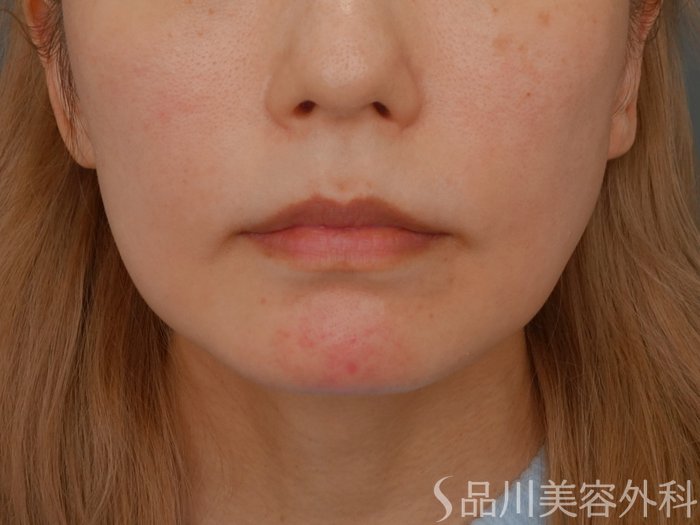 症例NO.72467のBEFORE写真