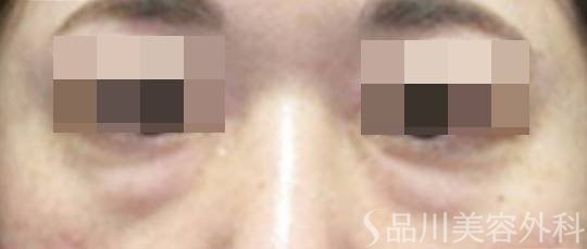 症例NO.74553のBEFORE写真