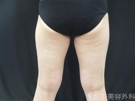 症例NO.54099のAFTER写真