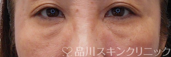 症例NO.69963のBEFORE写真