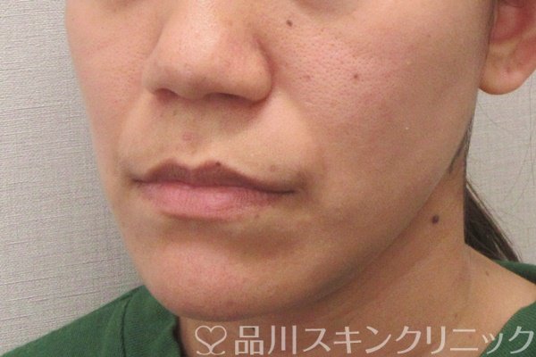 症例NO.70203のBEFORE写真