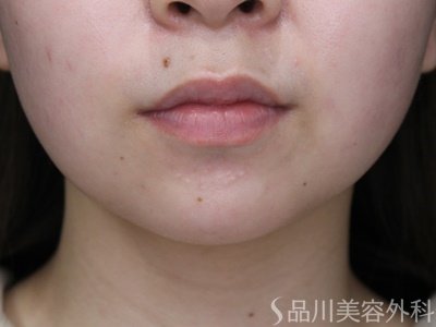 症例NO.69966のBEFORE写真