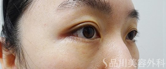 症例NO.69882のAFTER写真