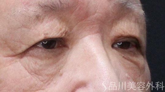 症例NO.74742のBEFORE写真