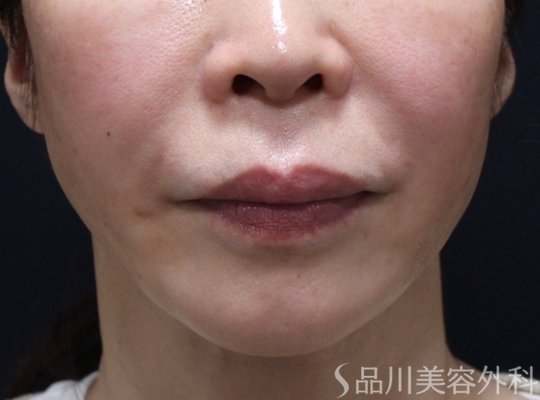 症例NO.73110のAFTER写真