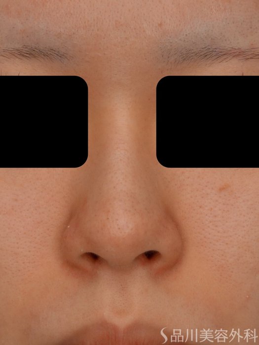 症例NO.73734のBEFORE写真