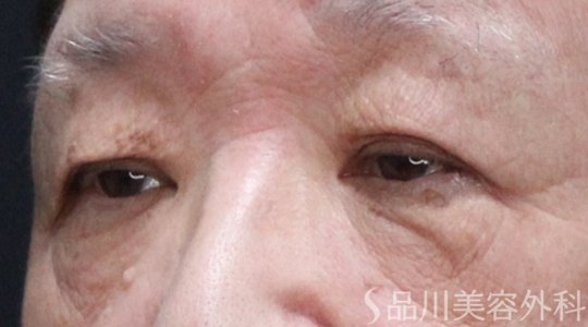症例NO.74742のBEFORE写真