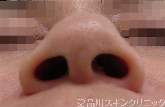 症例NO.33428のBEFORE写真