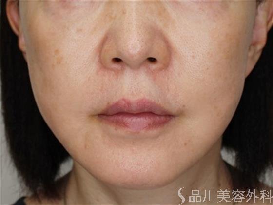 症例NO.51939のBEFORE写真