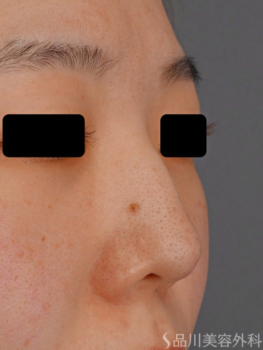 症例NO.73781のBEFORE写真