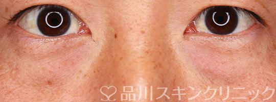 症例NO.75383のBEFORE写真