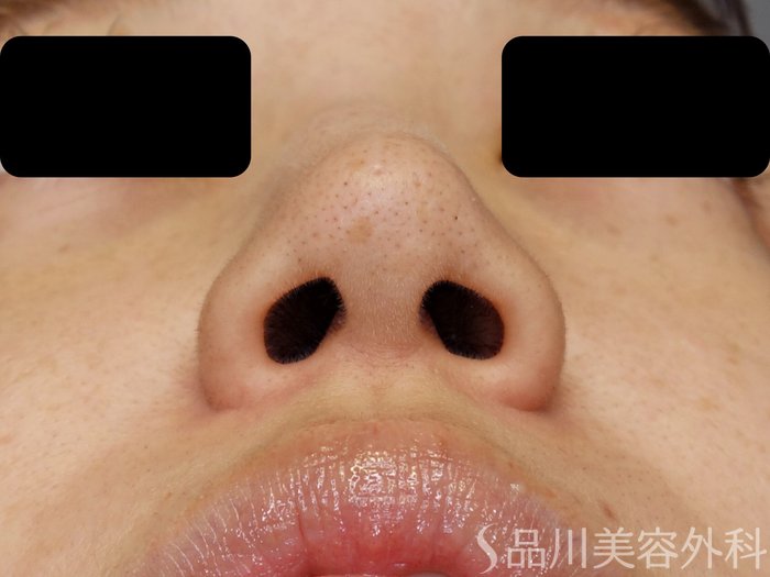 症例NO.71204のBEFORE写真