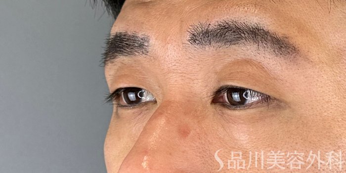 症例NO.70620のBEFORE写真