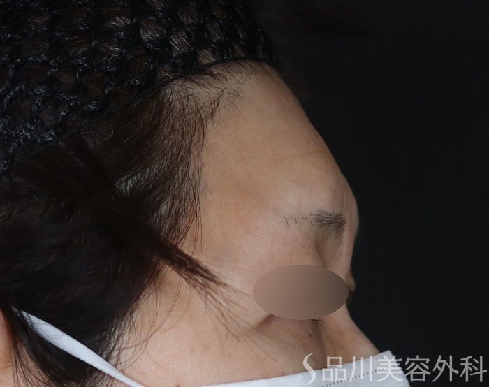 症例NO.72930のBEFORE写真