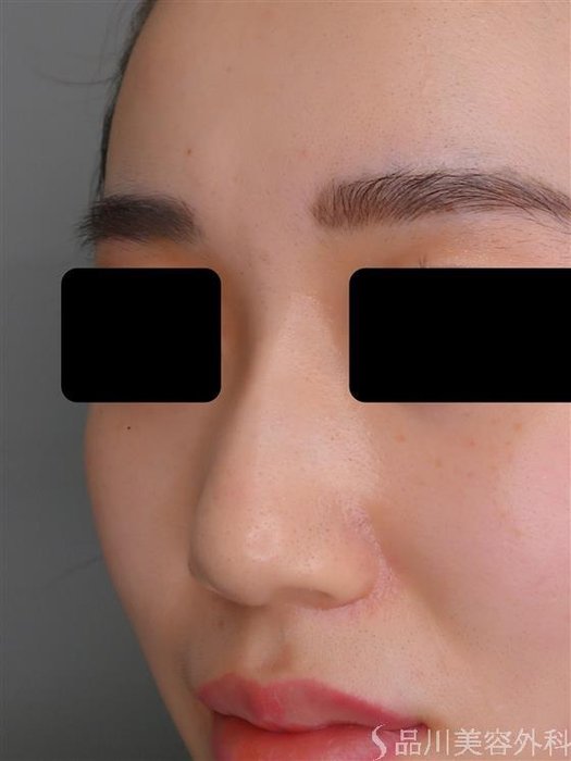 症例NO.55046のBEFORE写真