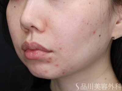 症例NO.72647のBEFORE写真