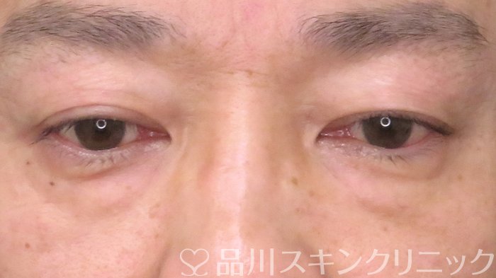症例NO.69714のBEFORE写真