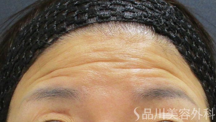 症例NO.65672のBEFORE写真
