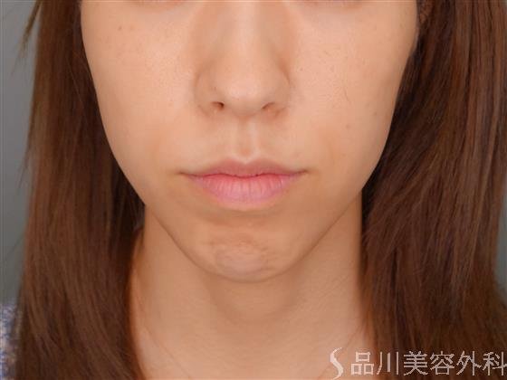 症例NO.51427のBEFORE写真