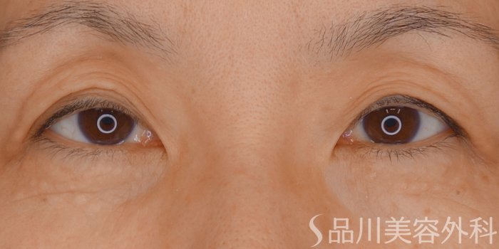 症例NO.72495のBEFORE写真