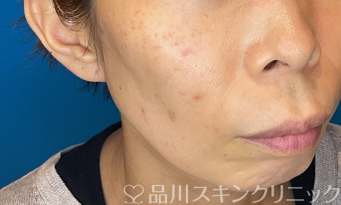 症例NO.74511のBEFORE写真