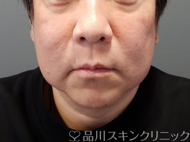 症例NO.68572のBEFORE写真