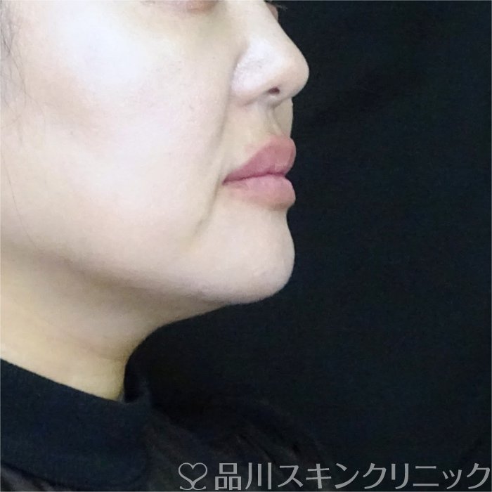 症例NO.70950のAFTER写真